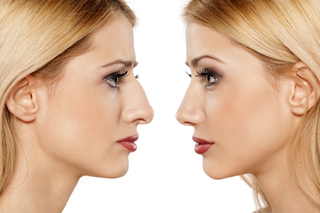 What Can You Expect from Rhinoplasty?