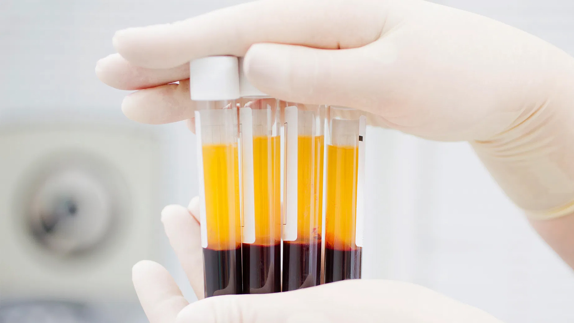 Speed Up Your Recovery with Platelet Rich Fibrin