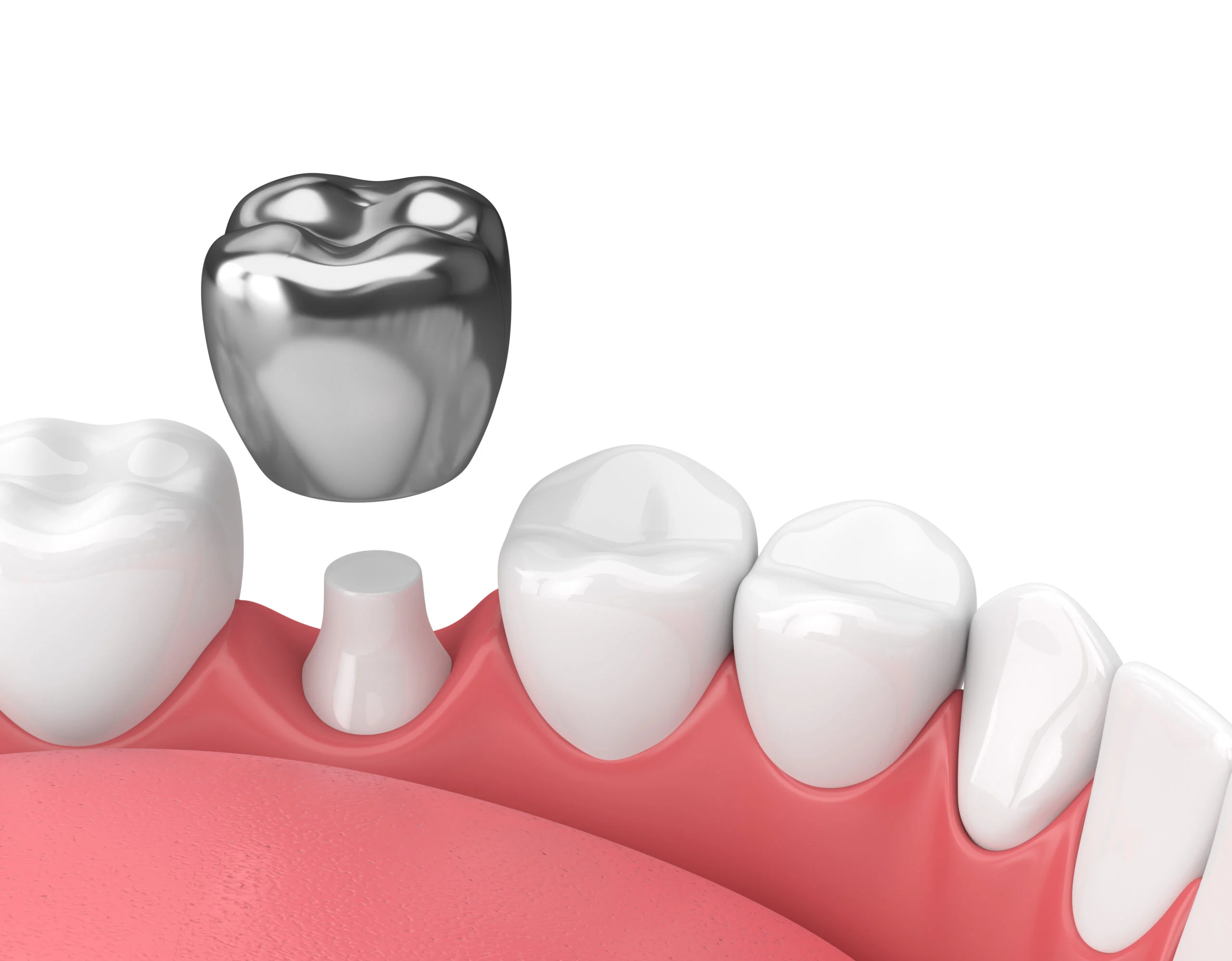 Your easy guide to understanding dental crowns