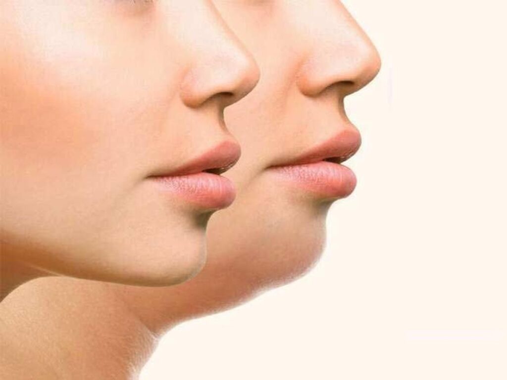 Fat Cheeks: Causes and Treatments
