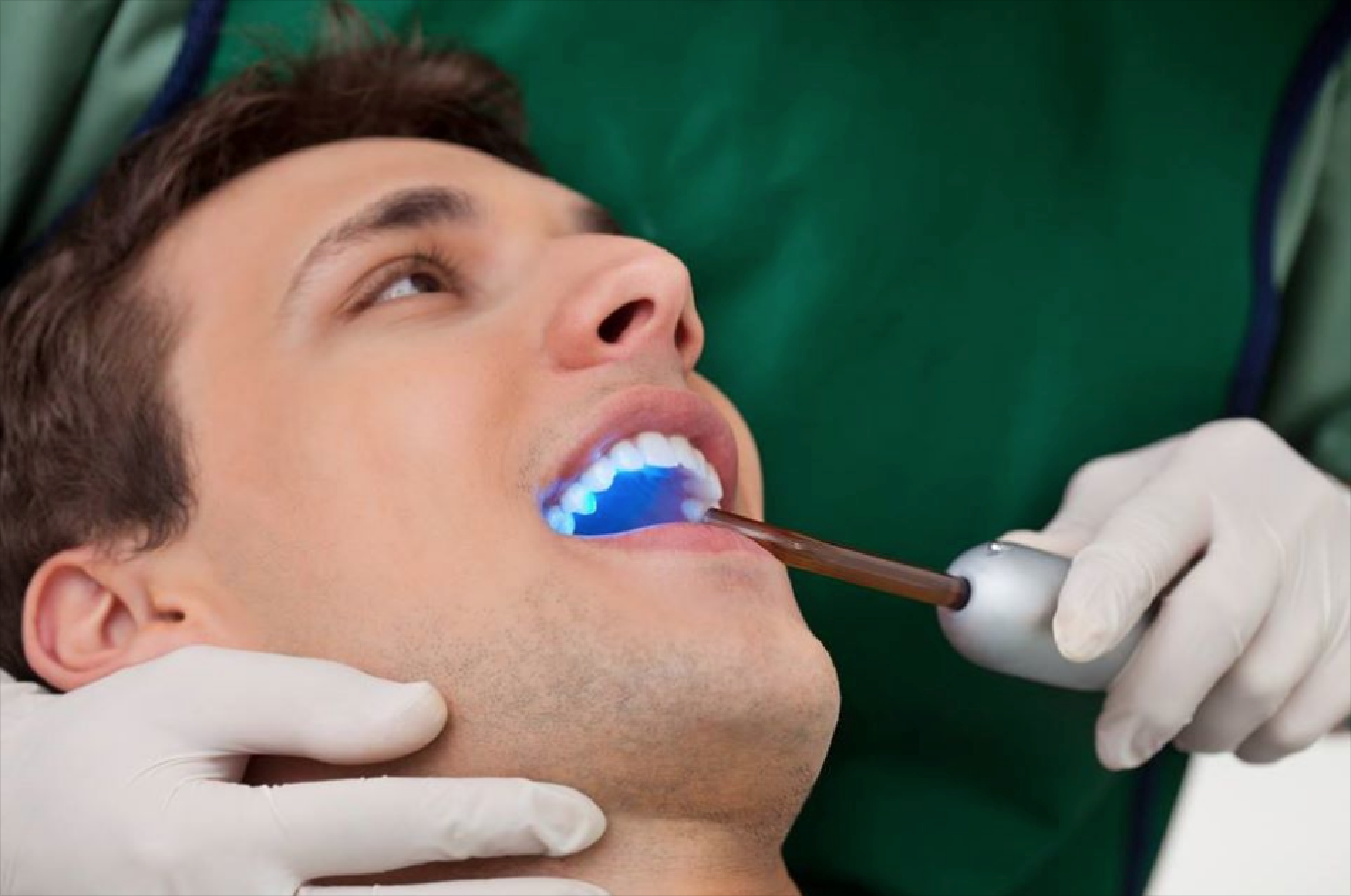 Most Asked Questions About Dental Composite Bonding in Greenbelt