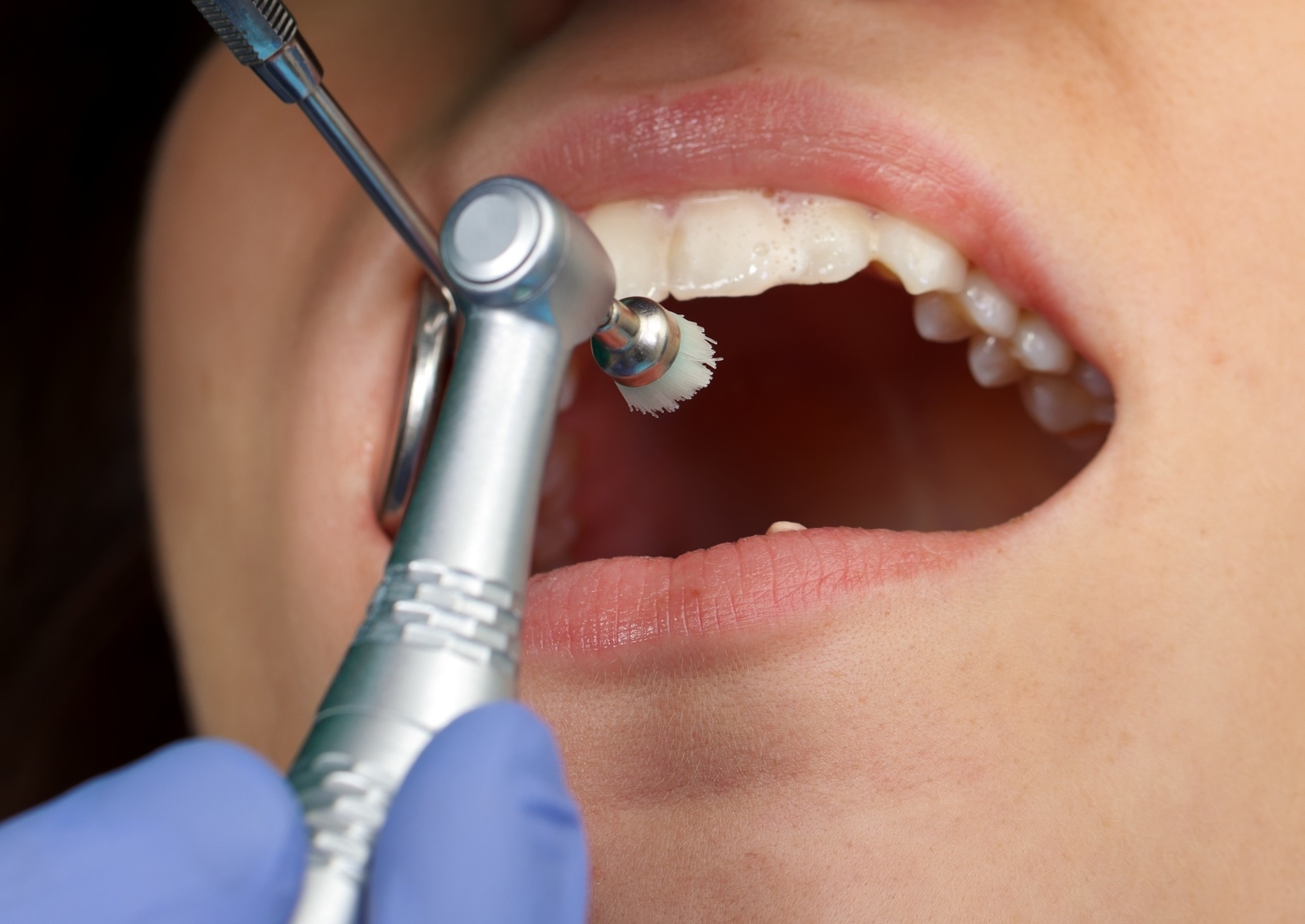 What Does Professional Dental Cleaning in Plymouth, MA, Involve?