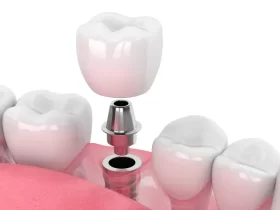 dental implants