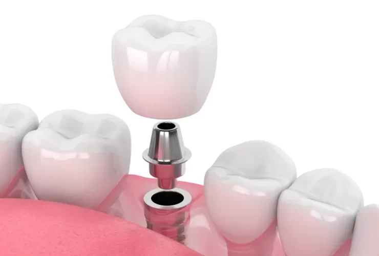 dental implants
