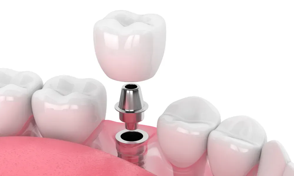 dental implants