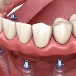 Mini dental implants