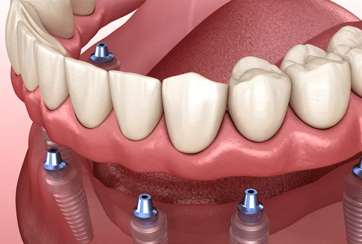 Mini dental implants