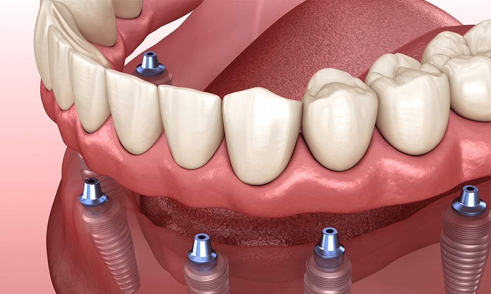Mini dental implants