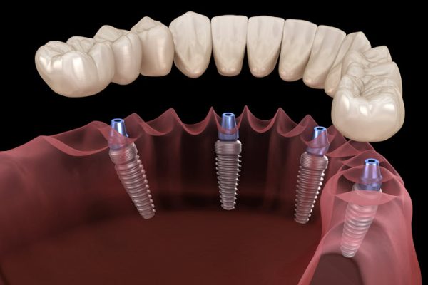 all-on-4 dental implants