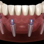 all-on-4 dental implants