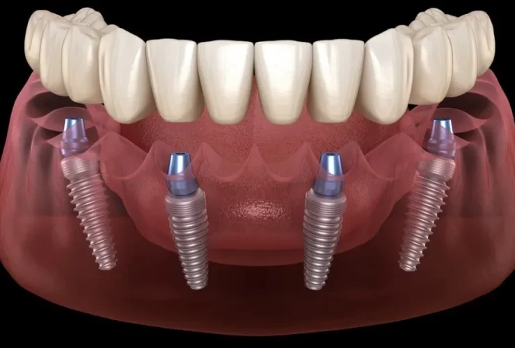 all-on-4 dental implants