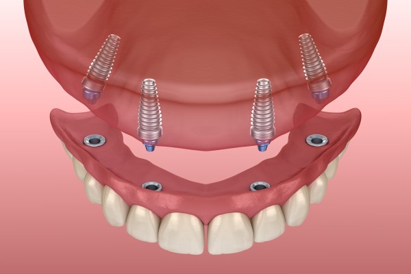 all-on-4-dental-implants