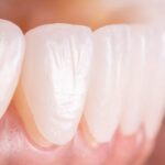 dental veneers