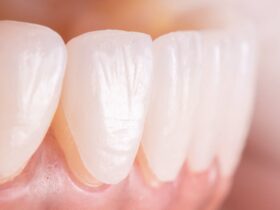 dental veneers