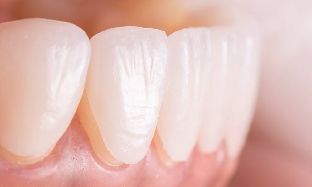 dental veneers