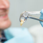 Wisdom Teeth Removal