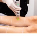 Is Full Body Laser Hair Removal Worth It? Breaking Down the Cost and Benefits