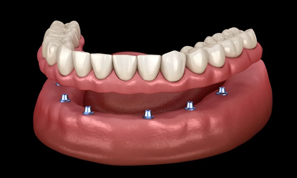 5 Reasons Implants Can Cost Less Over Time Than Bridges or Dentures: Insights From Stubbs Dental and Other Utah Providers